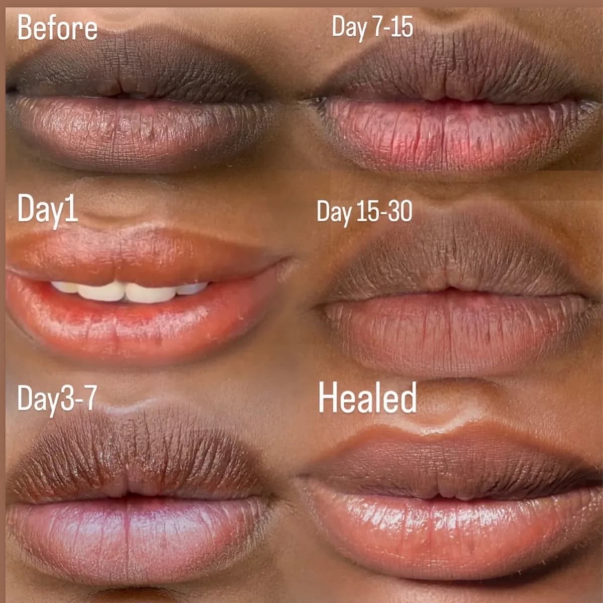 Dark Lips Neutralization