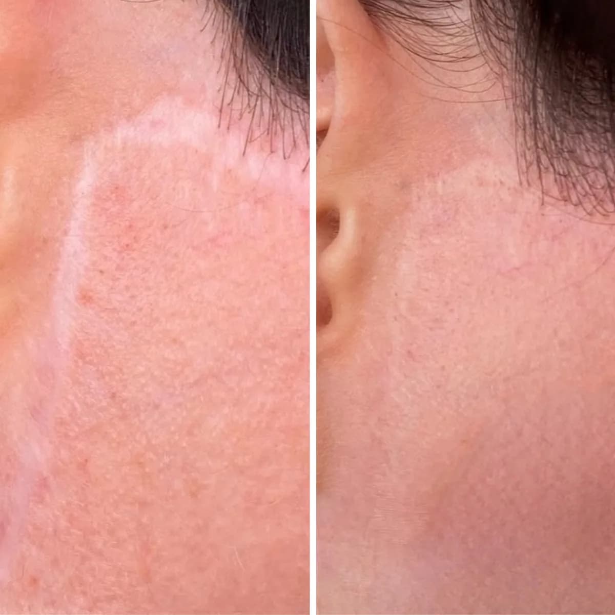 Scar Camouflage & 3D Areola