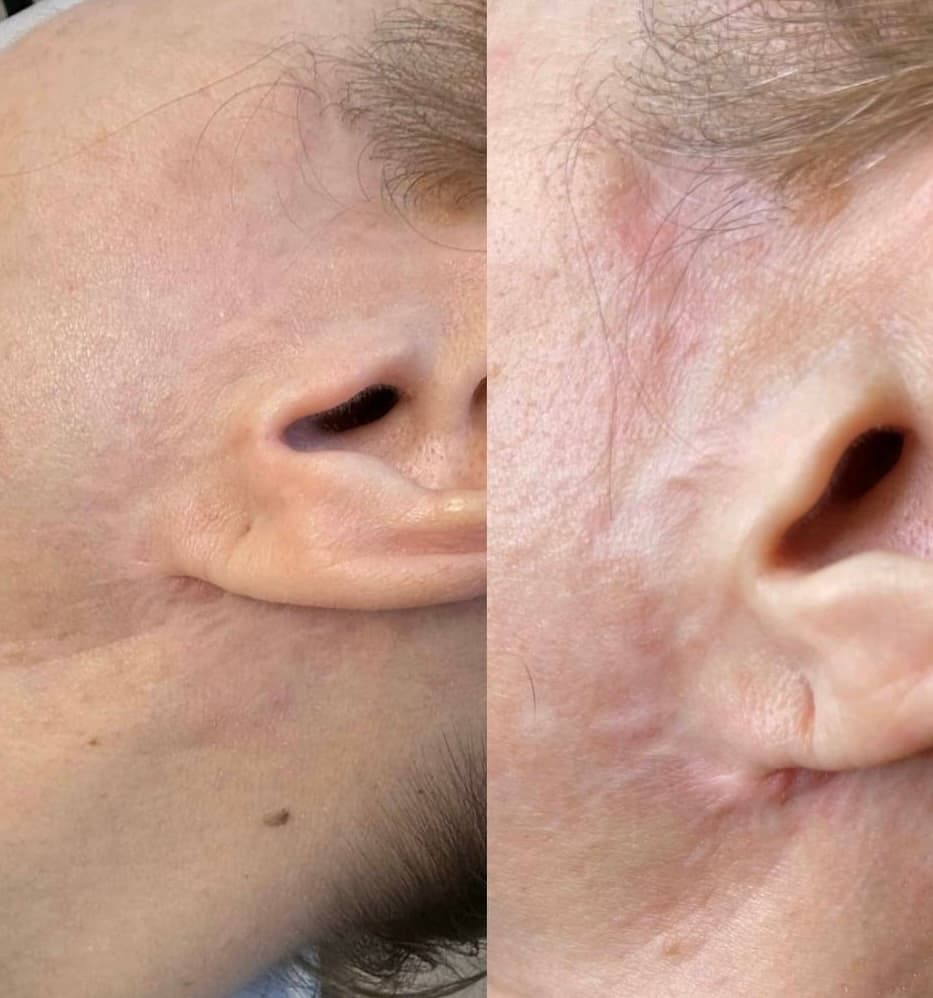 Scar Camouflage & 3D Areola result 2