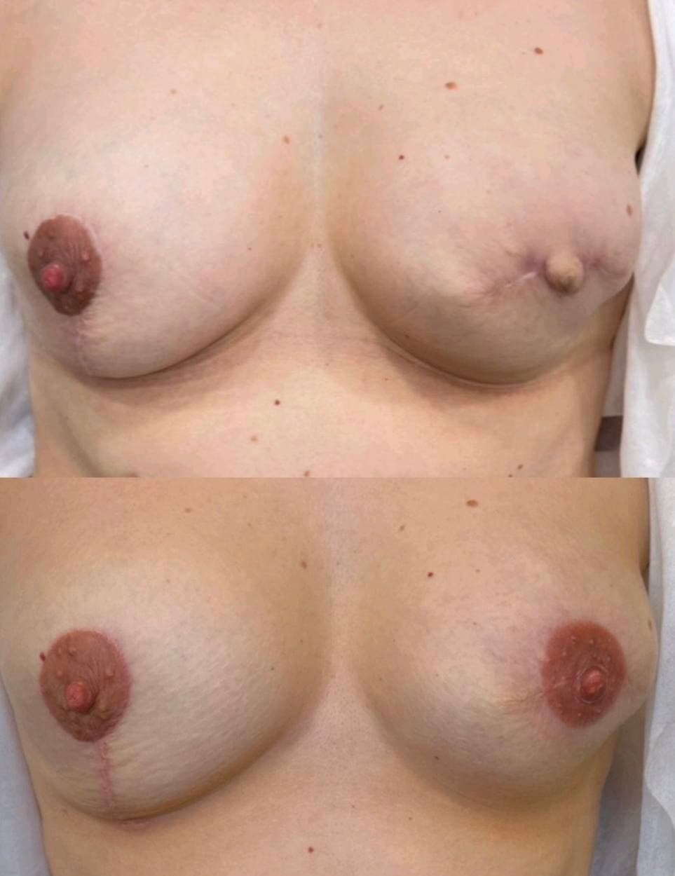 Scar Camouflage & 3D Areola result 4