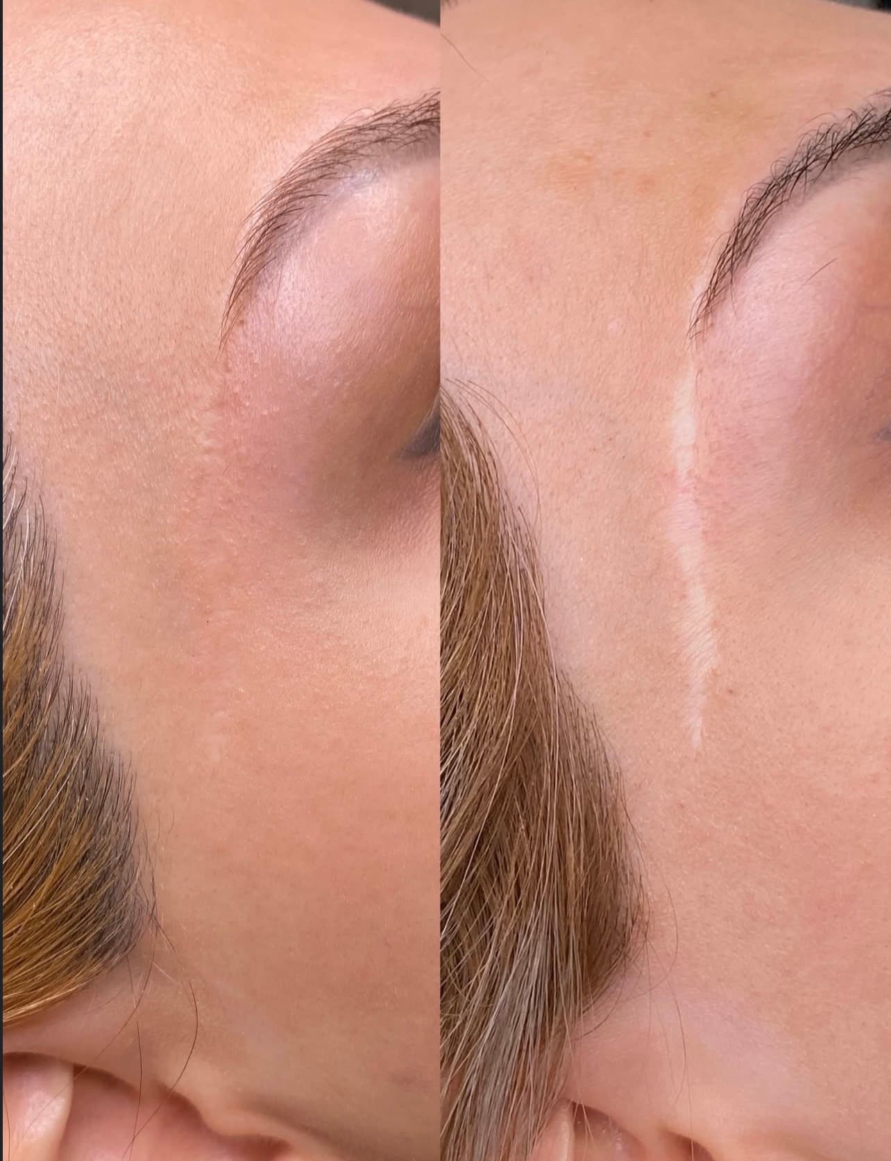 Scar Camouflage & 3D Areola result 5