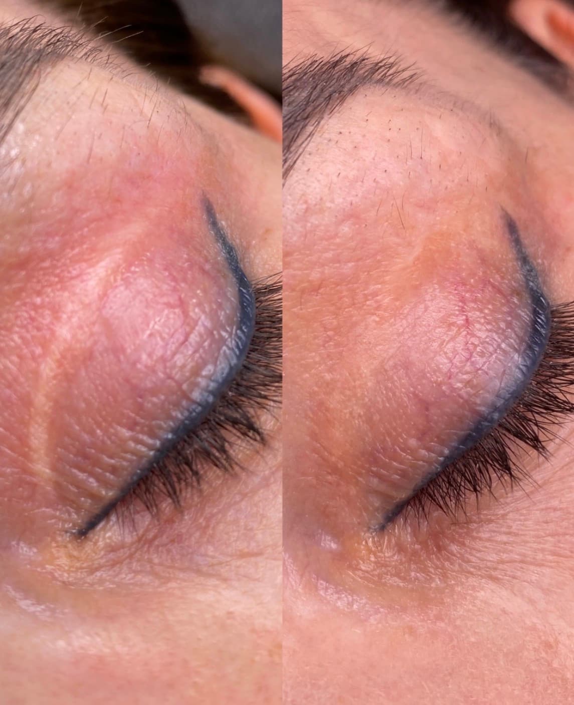 Scar Camouflage & 3D Areola result 6