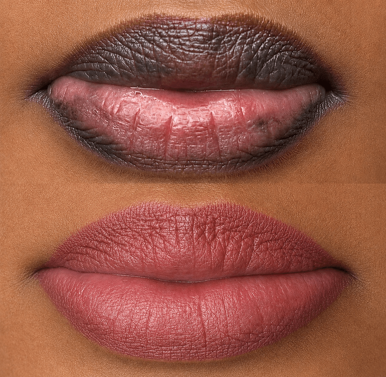 Dark Lips Neutralization