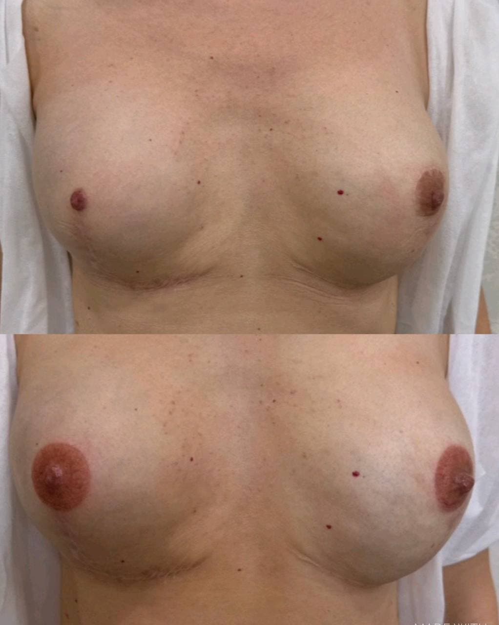 Areola Restoration result 3