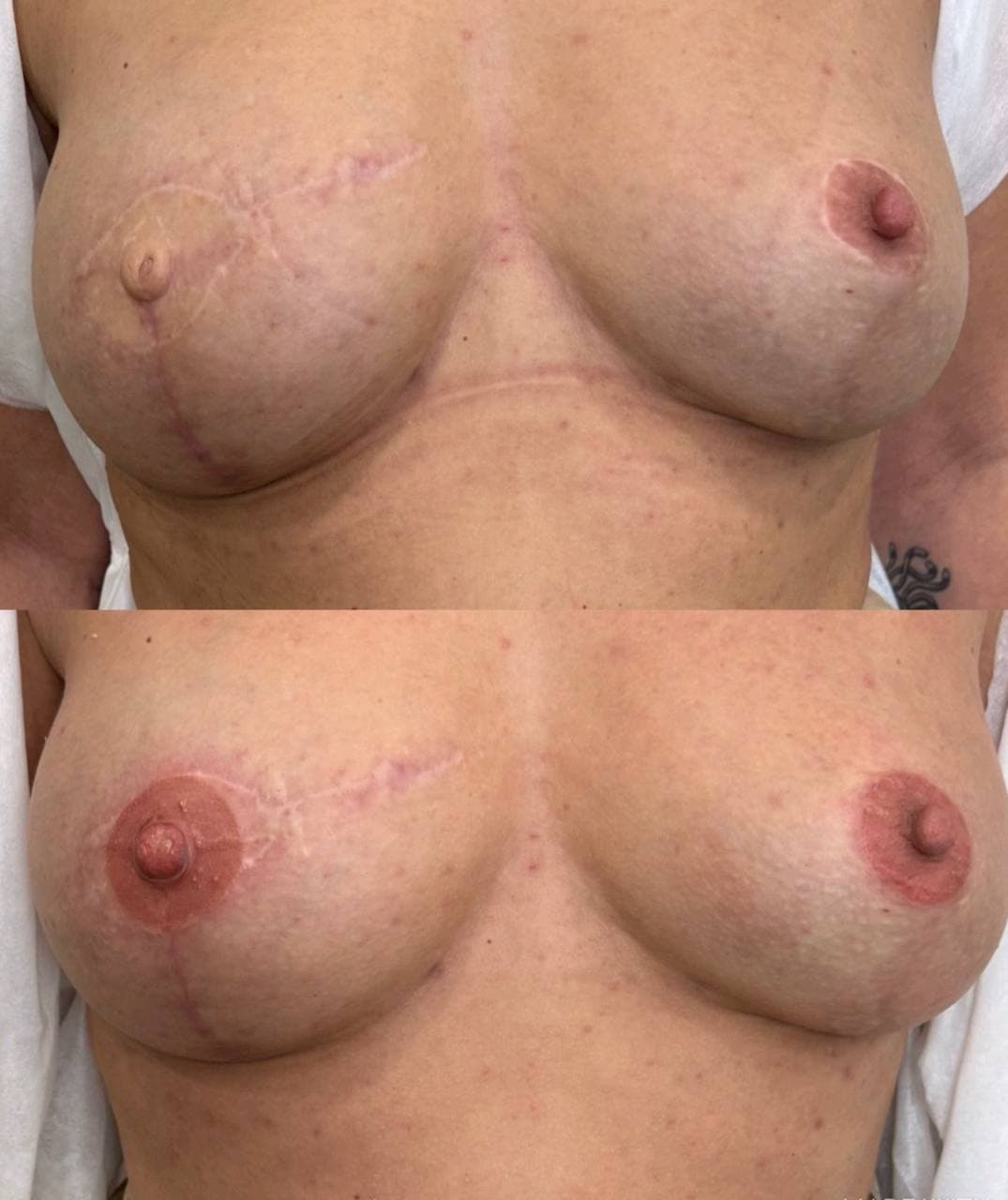 Areola Restoration result 5