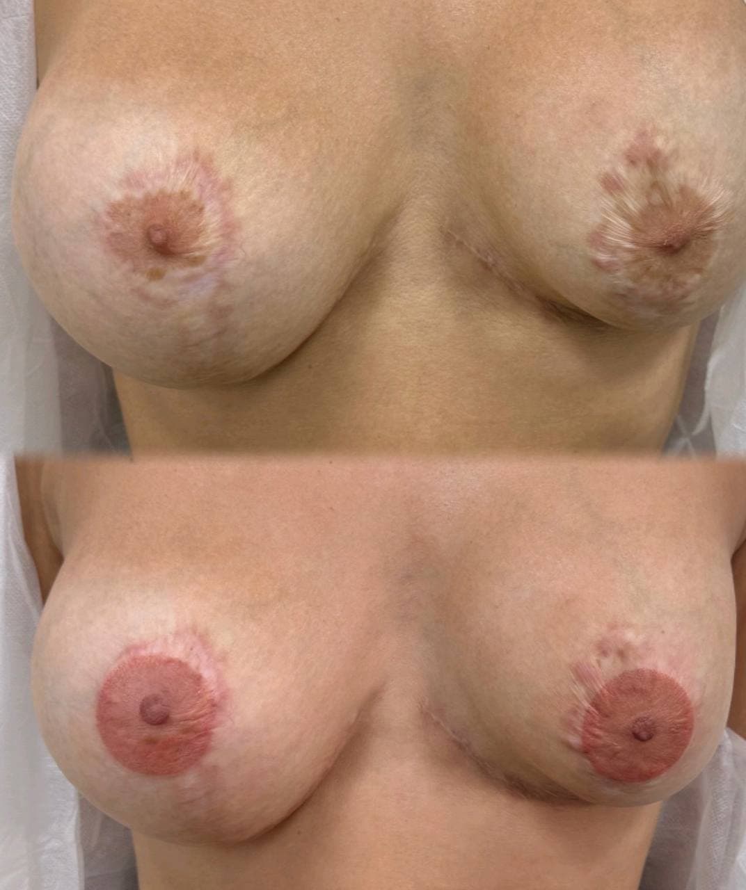 Areola Restoration result 7