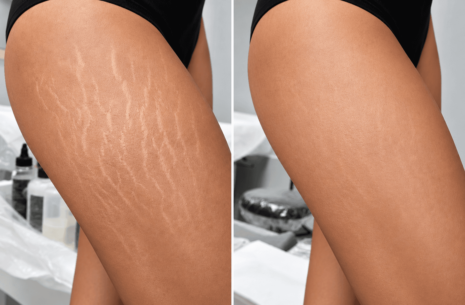 Stretch Marks Camouflage result 1