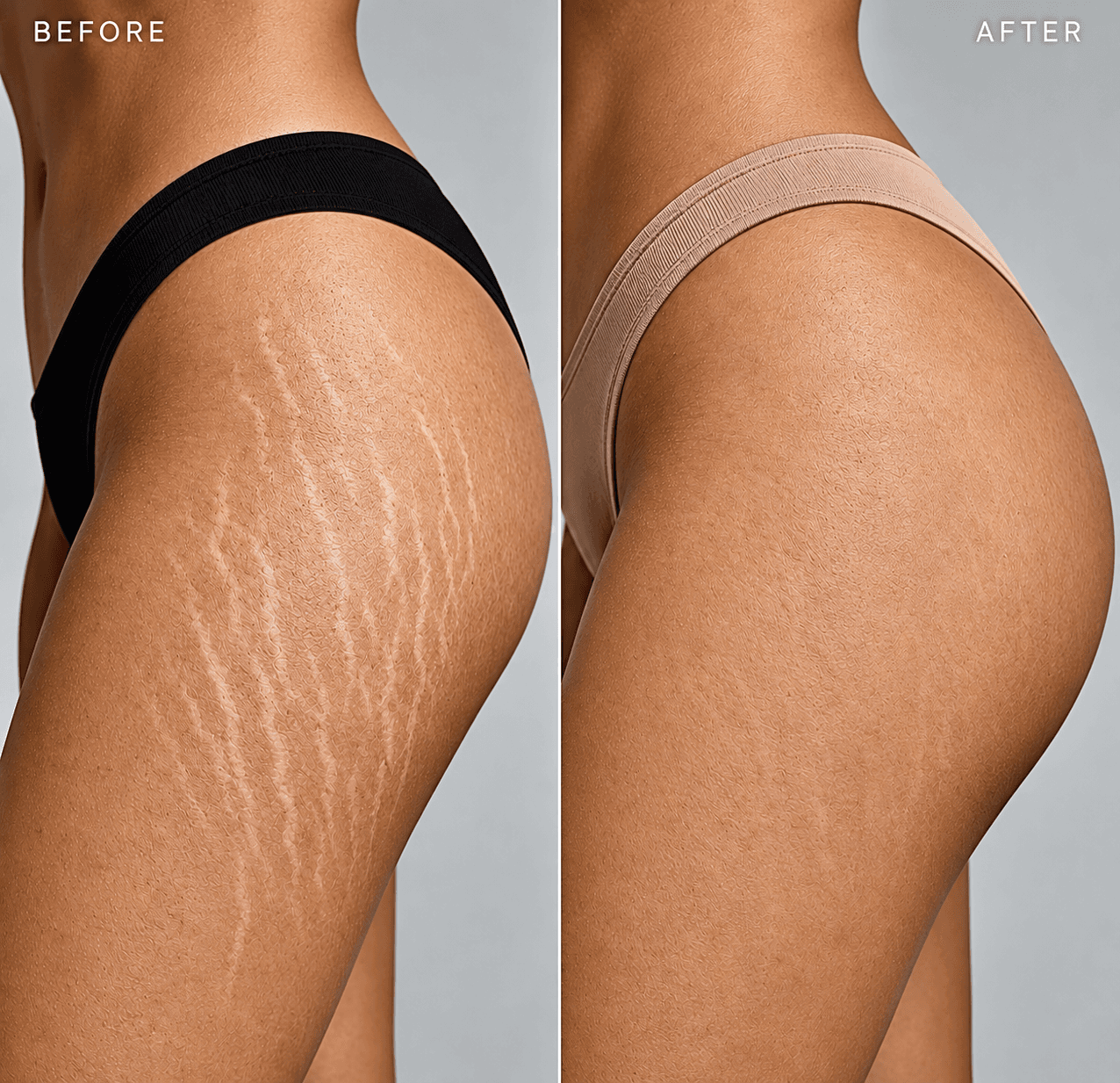 Stretch Marks Camouflage result 2